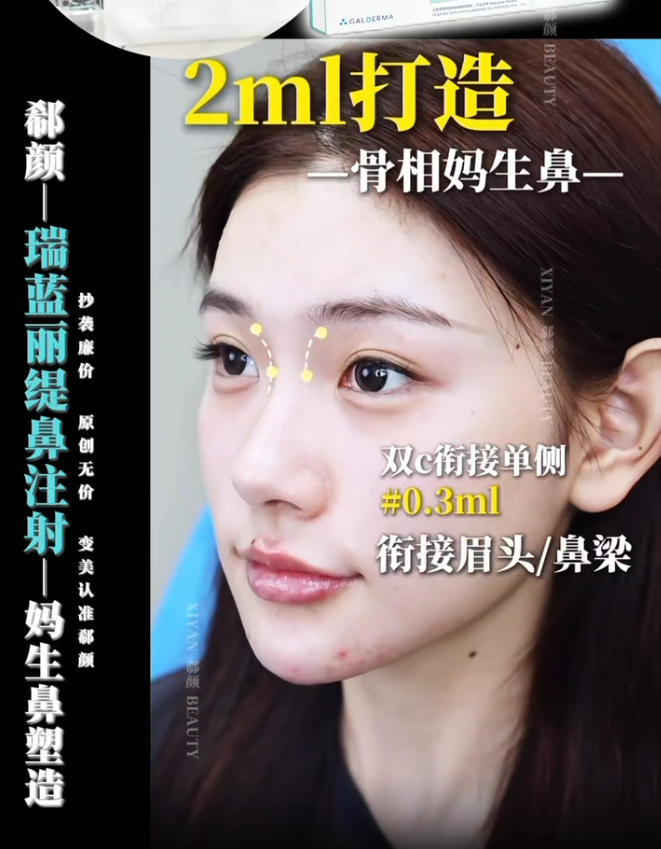 Shanghais zarte Nase ohne Surgery_Shen Yaxins raffinierte Naseninjektionsbox